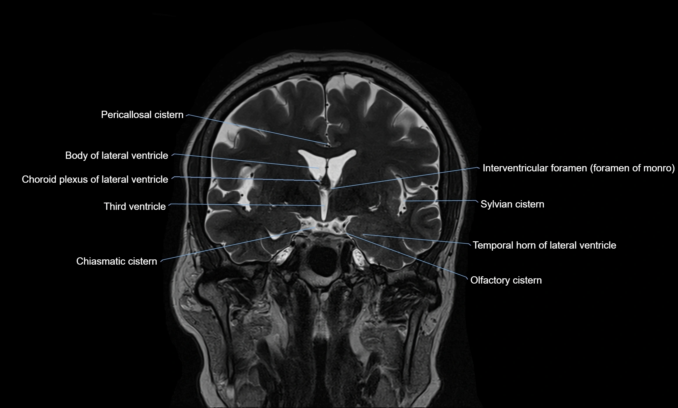 Brain cisterns  and ventricles coronal anatomy 3T MRI image-img-00001-00025.webp